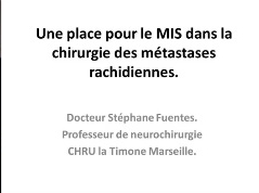 Prise en charge des métastases rachidiennes (5/5) - Une place pour le MIS dans la chirurgie des métastases rachidiennes