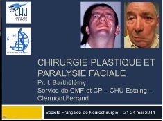 Prise en charge et réhabilitation des paralysies du nerf faciale (3/4) - Chirurgie plastique et paralysie faciale