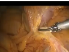 Procedure And Results Of Retrocolic Roux-En Y Anastomosis For Laparoscopic Distal Gastrectomy -Fix T