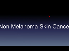 Prognostic Factors and the Role of Adjuvant Radiation Therapy in Non-Melanoma Skin Cancer of the Head and Neck Prognostic Factors and the Role of Adjuvant Radiation Therapy in Non-Melanoma Skin Cancer of the Head and Neck
