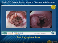 Prohylactic Mesh for Parastomal Hernias?