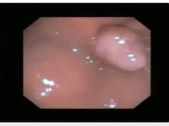 Prolapsing Gastric Mucosa At Gastrostomy