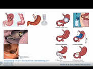 Pros and Cons of Endoscopic Procedures for Obesity
