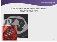 Prostheses and adjuncts in chest wall surgery Prostheses and adjuncts in chest wall surgery
