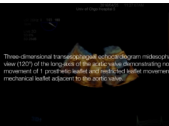 Prosthetic Mitral Valve Obstruction - 3D Echo