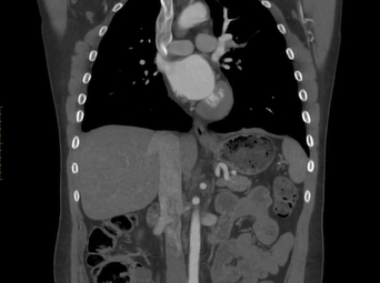 "Pseudo" Coarctation of Aorta (ALAN B. LUMSDEN, MD; THOMAS E. MACGILLIVRAY, MD; SASHI INKOLLU, MD) "Pseudo" Coarctation of Aorta (ALAN B. LUMSDEN, MD; THOMAS E. MACGILLIVRAY, MD; SASHI INKOLLU, MD)