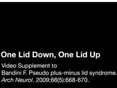 Pseudo Plus-Minus Lid Syndrome Pseudo Plus-Minus Lid Syndrome