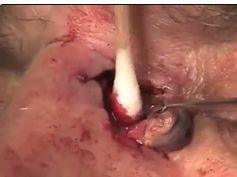Pseudoaneurysm Repair in Case 1