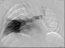 Pulmonary Artery Embolectomy using the INARI FlowTriever Pulmonary Artery Embolectomy using the INARI FlowTriever