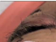 Pulsatile Exophthalmos: Effect of Orthostatic Pressure Difference Pulsatile Exophthalmos: Effect of Orthostatic Pressure Difference