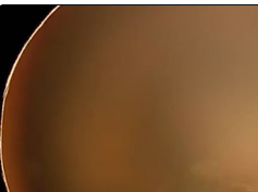 Pulsating Long Posterior Ciliary Artery Pulsating Long Posterior Ciliary Artery