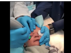 Pulsed Dye Laser Treatment of Infants Port-Wine Stains