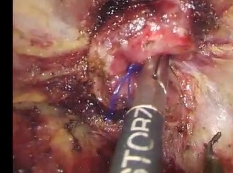 Purse-string Reinforcement in TaTME: a Further Essential Step to Increase Oncological Safety Purse-string Reinforcement in TaTME: a Further Essential Step to Increase Oncological Safety