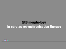QRS morphology in cardiac resynchronisation therapy