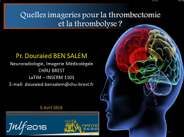 Quelles imageries pour la thrombectomie et la thrombolyse ?