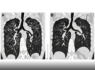 Quels progrès dans le traitement de l'HL pulmonaire de l'adulte ?