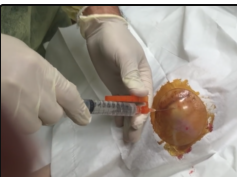 R knee joint infection - drainage of pus