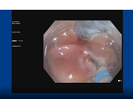 Résection complète et R0 par dissection sous-muqueuse hybride et FTRD d'une lésion adénomateuse infiltrant profondément l'orifice appendiculaire