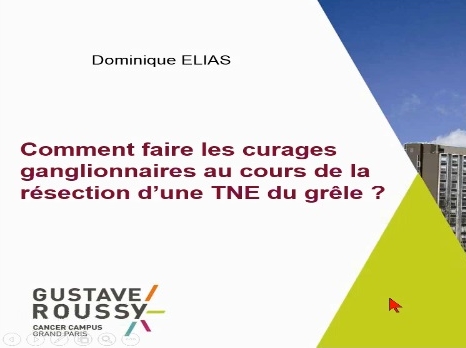 Résection d'une tumeur neuroendocrine du grêle avec envahissement mésentérique Résection d'une tumeur neuroendocrine du grêle avec envahissement mésentérique