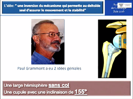Résultat des prothèses inversées d'épaules avec un recul minimum de 10 ans