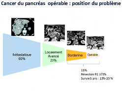 Résultats de l'étude ESPAC-4 multicentrique internationale de phase III randomisée comparant l'association gemcitabine-capécitabine à la gemcitabine en monothérapie chez les patients opérés d'un adénocarcinome du pancréas
