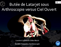 Résumé du symposium "Comparaison du Latarjet sous arthroscopie versus ciel ouvert" Résumé du symposium "Comparaison du Latarjet sous arthroscopie versus ciel ouvert"