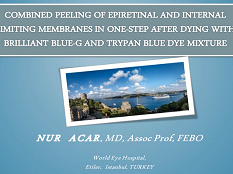 Rétine, Vitreux - Peeling combiné de membranes internes épirétinéale et interne en une fois, après leur mort dûe à une mixture bleue Trypan brillante Rétine, Vitreux - Peeling combiné de membranes internes épirétinéale et interne en une fois, après leur mort dûe à une mixture bleue Trypan brillante