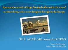 Rétine, Vitreux - Retrait bimanuel de larges corps étrangers avec un coup de suture, et un forceps nouvellement designé Rétine, Vitreux - Retrait bimanuel de larges corps étrangers avec un coup de suture, et un forceps nouvellement designé