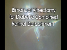 Rétine, Vitreux - Vitrectomie bimanuelle pour un détachement rétineux associé à un diabète Rétine, Vitreux - Vitrectomie bimanuelle pour un détachement rétineux associé à un diabète