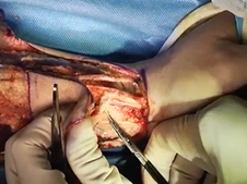 Radial forearm free flap