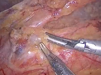 Radical Apical Lymph Node Dissection with Carbon Nanoparticles in Laparoscopic Rectal Cancer Surgery Radical Apical Lymph Node Dissection with Carbon Nanoparticles in Laparoscopic Rectal Cancer Surgery
