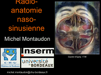 Radioanatomie des sinus de la face et variantes