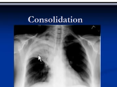 Radiology interpretation, Pneumonia diagnosis to treatment and laboratory tests Radiology interpretation, Pneumonia diagnosis to treatment and laboratory tests