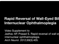 Rapid Reversal of Wall-Eyed Bilateral Internuclear Ophthalmoplegia Rapid Reversal of Wall-Eyed Bilateral Internuclear Ophthalmoplegia