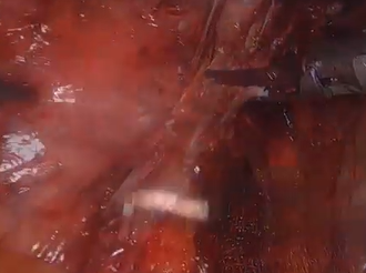 Re-do laparoscopic ventral rectopexy