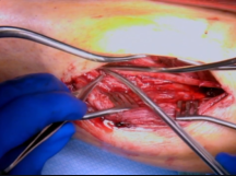 Re-exploration After Early Failure of a Distal RSV Graft Re-exploration After Early Failure of a Distal RSV Graft