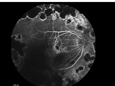 Real-Time Fluorescein Angiography Real-Time Fluorescein Angiography