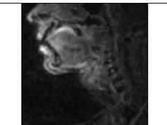 Real-Time Magnetic Resonance Imaging in Patient 1
