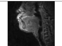 Real-Time Magnetic Resonance Imaging in Patient 2