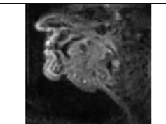 Real-Time Magnetic Resonance Imaging in Patient 3