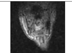 Real-Time Magnetic Resonance Imaging in Patient 4