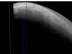 Reconstituted 3-Dimensional Anterior-Segment Optical Coherence Tomographic Images of a Filtering Ble Reconstituted 3-Dimensional Anterior-Segment Optical Coherence Tomographic Images of a Filtering Ble