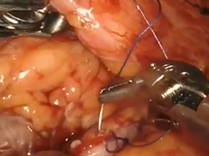 Reconstruction of Two Concurrent Ipsilateral Ureteral Strictures