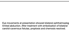 Recovery From Ophthalmoplegia and Proptosis After Bilateral Carotid-Cavernous Sinus Fistula Repair Recovery From Ophthalmoplegia and Proptosis After Bilateral Carotid-Cavernous Sinus Fistula Repair
