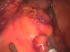 Rectal Eversion and Coloanal Anastomosis: A Classical Technique We Should Not Forget. Rectal Eversion and Coloanal Anastomosis: A Classical Technique We Should Not Forget.
