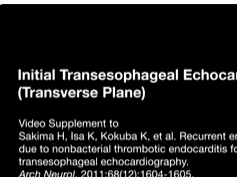 Recurrent Embolic Stroke Due to Nonbacterial Thrombotic Endocarditis Followed by Transesophageal Ech-1 Recurrent Embolic Stroke Due to Nonbacterial Thrombotic Endocarditis Followed by Transesophageal Ech-1