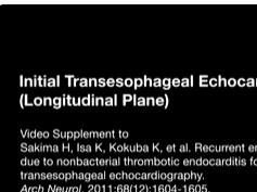 Recurrent Embolic Stroke Due to Nonbacterial Thrombotic Endocarditis Followed by Transesophageal Ech-2 Recurrent Embolic Stroke Due to Nonbacterial Thrombotic Endocarditis Followed by Transesophageal Ech-2