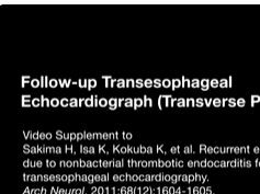 Recurrent Embolic Stroke Due to Nonbacterial Thrombotic Endocarditis Followed by Transesophageal Ech-3 Recurrent Embolic Stroke Due to Nonbacterial Thrombotic Endocarditis Followed by Transesophageal Ech-3
