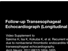 Recurrent Embolic Stroke Due to Nonbacterial Thrombotic Endocarditis Followed by Transesophageal Ech-4 Recurrent Embolic Stroke Due to Nonbacterial Thrombotic Endocarditis Followed by Transesophageal Ech-4