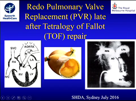 Redo pulmonary valve replacement after Tetralogy of Fallot